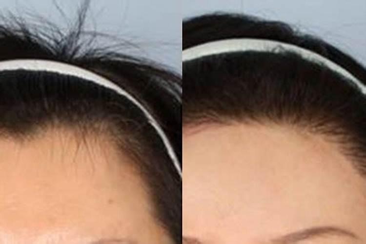 发际线过高的女人面相有什么讲究