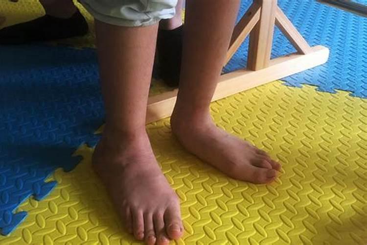 宝宝走路内八如何纠正？