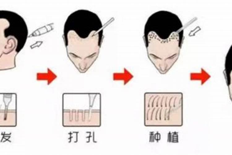 植发会影响运势吗？
