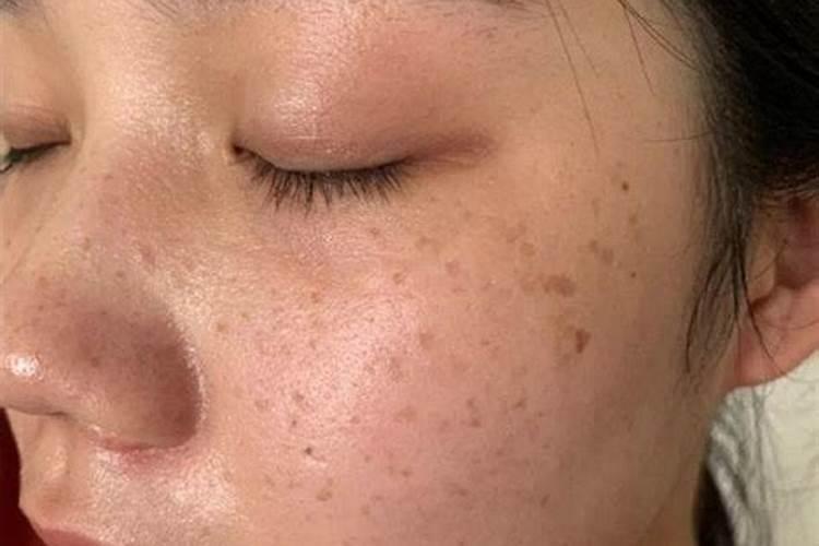 梦见脸上长斑是什么意思