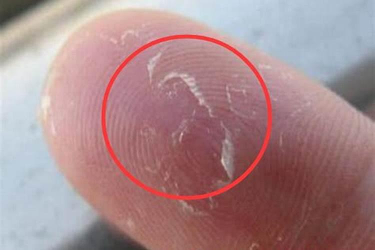 梦见手被烫了许多水泡的预兆