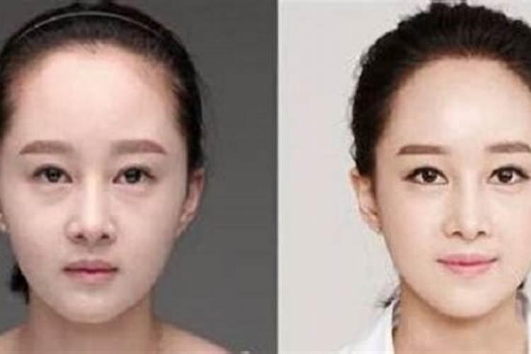 女孩发际线高,左侧发际线上长颗痣,现在己植发,是不是就破解不好的说法...