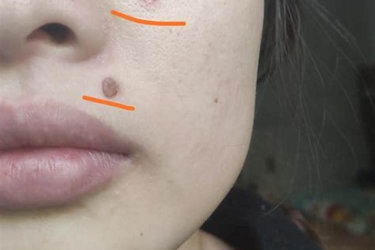 点痣后运气变了,关于面相点痣