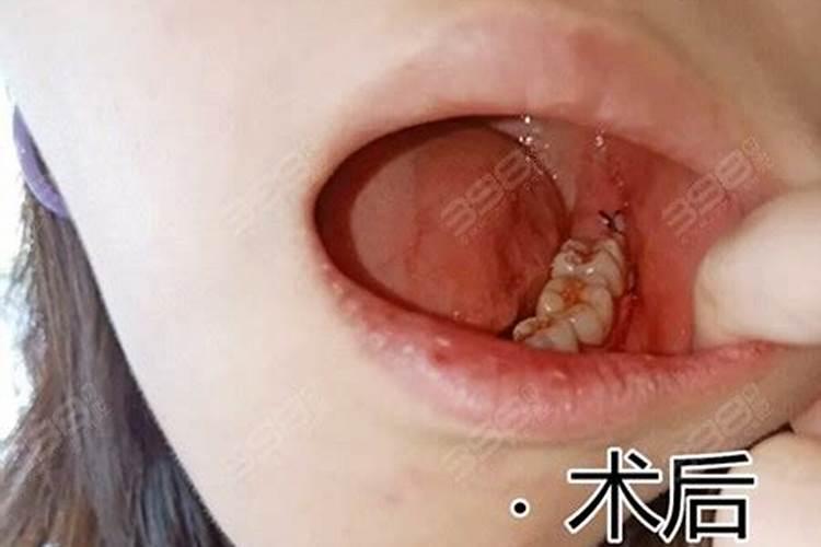 听老人说正月十五没过不能拔牙