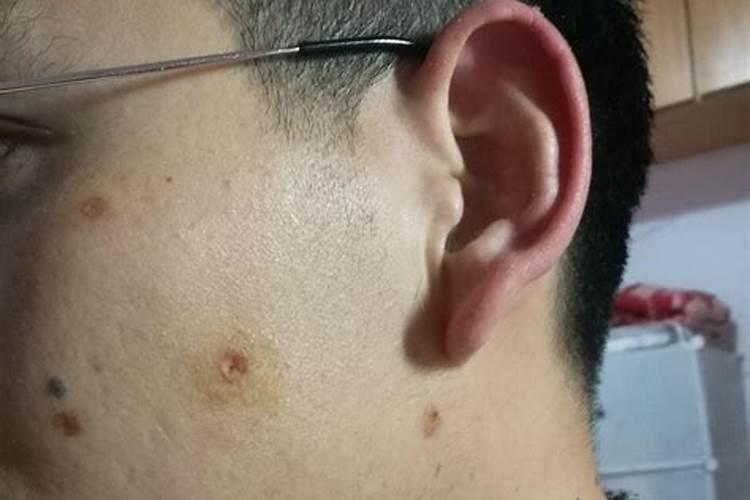 有没有点痣后运气改变的 点痣可以改变命运？