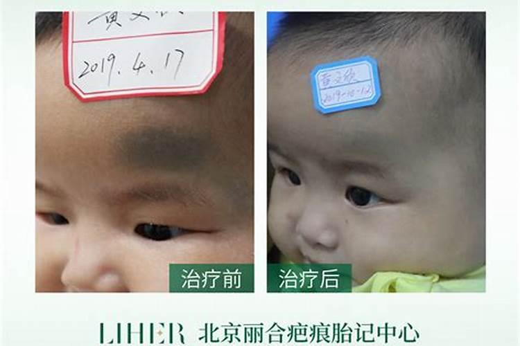 胎记算命对运势有何影响
