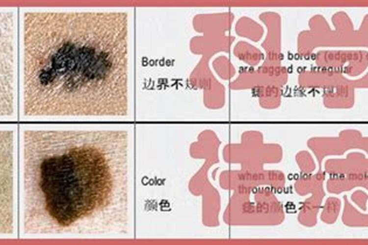 女生下巴痣上长毛是福还是祸