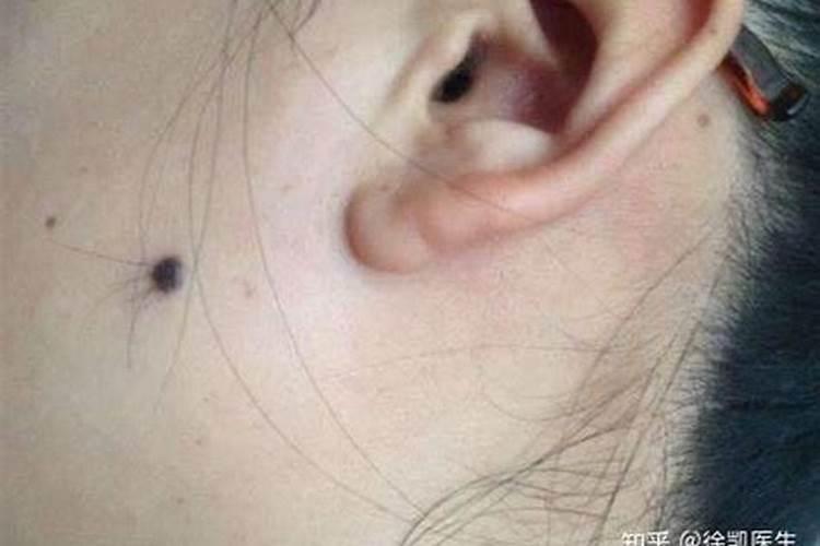 痣上长毛代表有福气