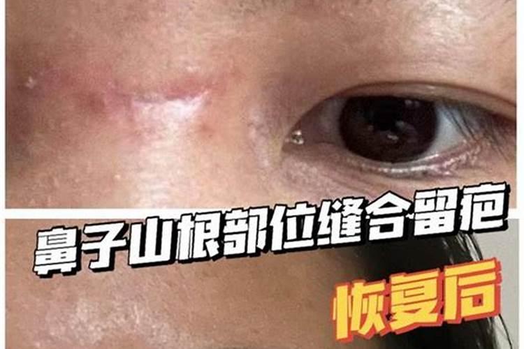 相术中说鼻梁有疤影响命运~为什么？会影响什么？
