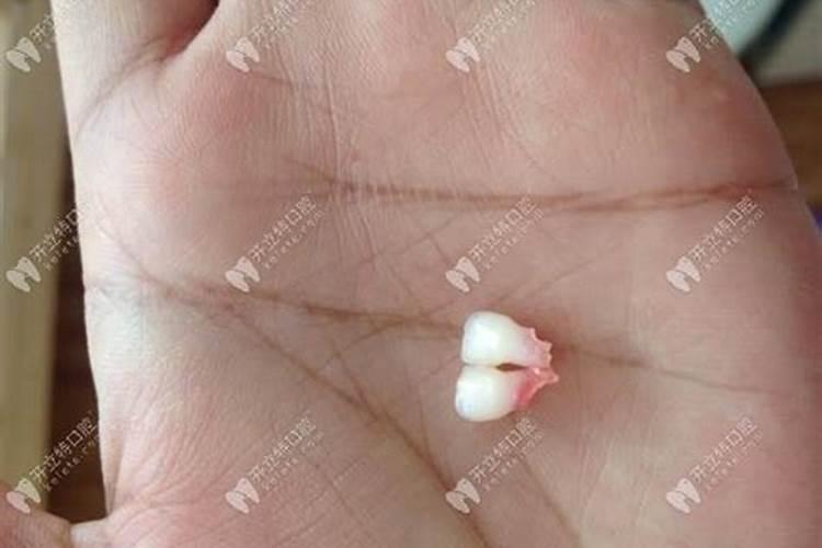 做梦梦到牙齿掉了一颗是什么意思？