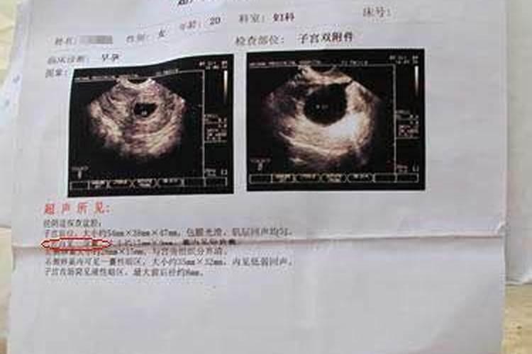 我13年怀了双胞胎因为一个发育的不好做了药流,今年三月份做了一次...