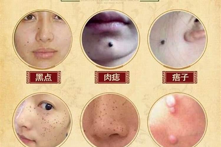 点痣对运势有影响吗