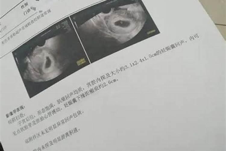 只有孕囊算不算有生命 孕囊形成后要注意什么
