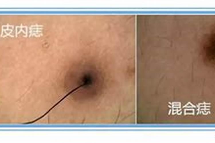 去掉痣后是不是改变了运势