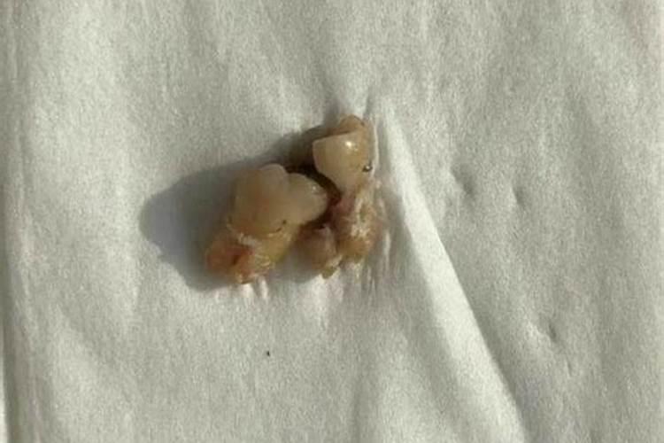 长智齿预示着什么运势？