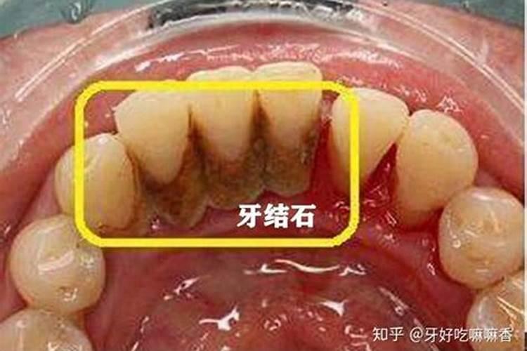 上牙齿掉了是什么意思