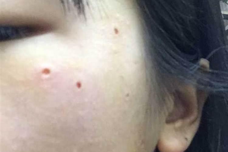 脸上长红痣是什么征兆？