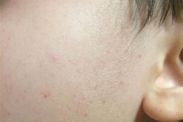 宝宝脸上突然长了红痣怎么回事